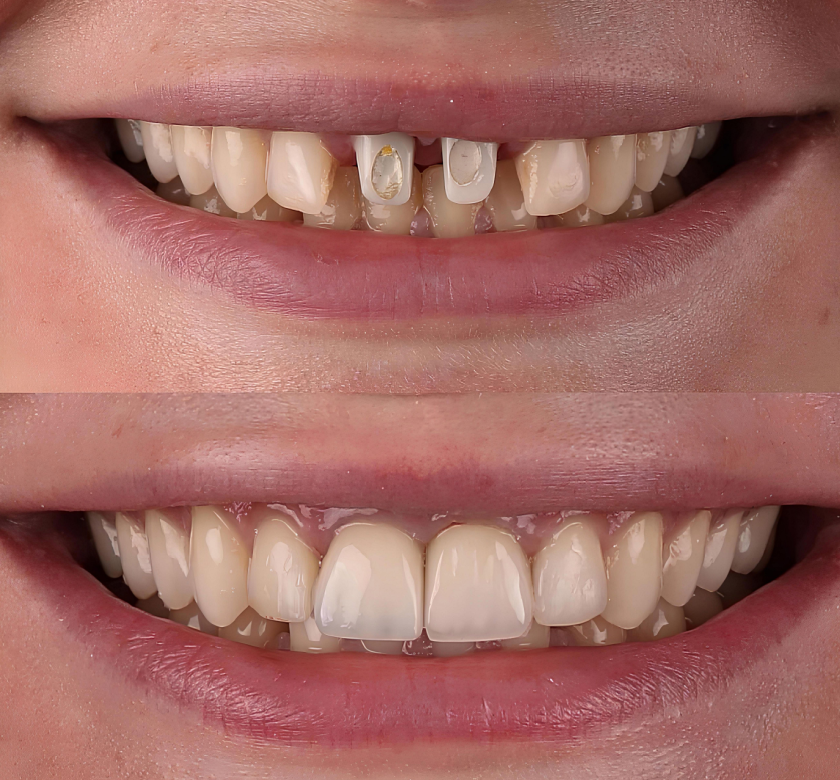 before and after dental crown