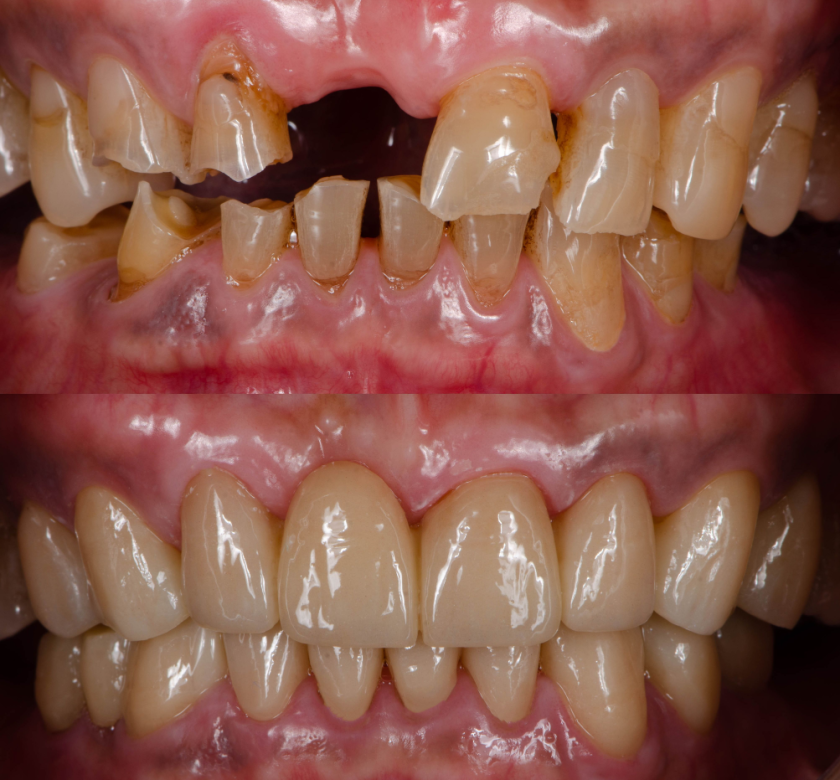 before and after dental implant bridge