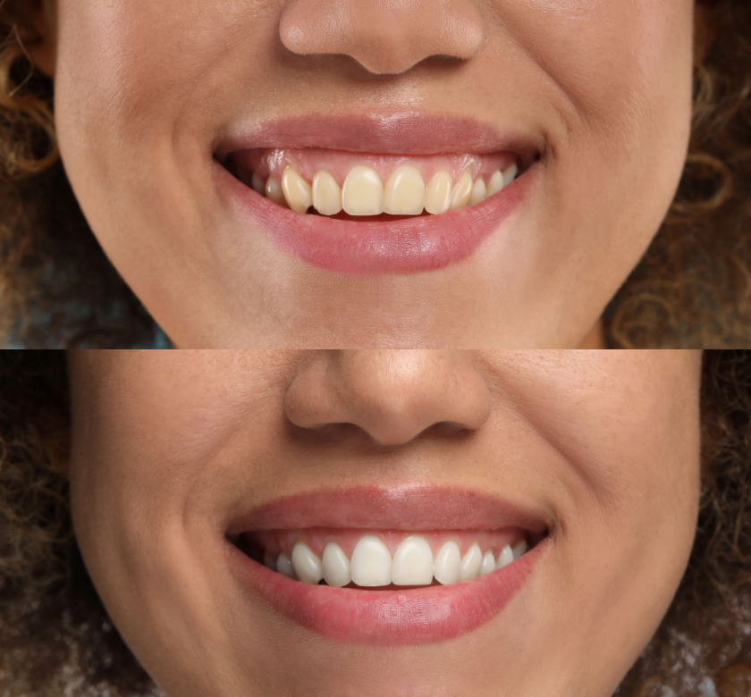 before and after teeth whitening