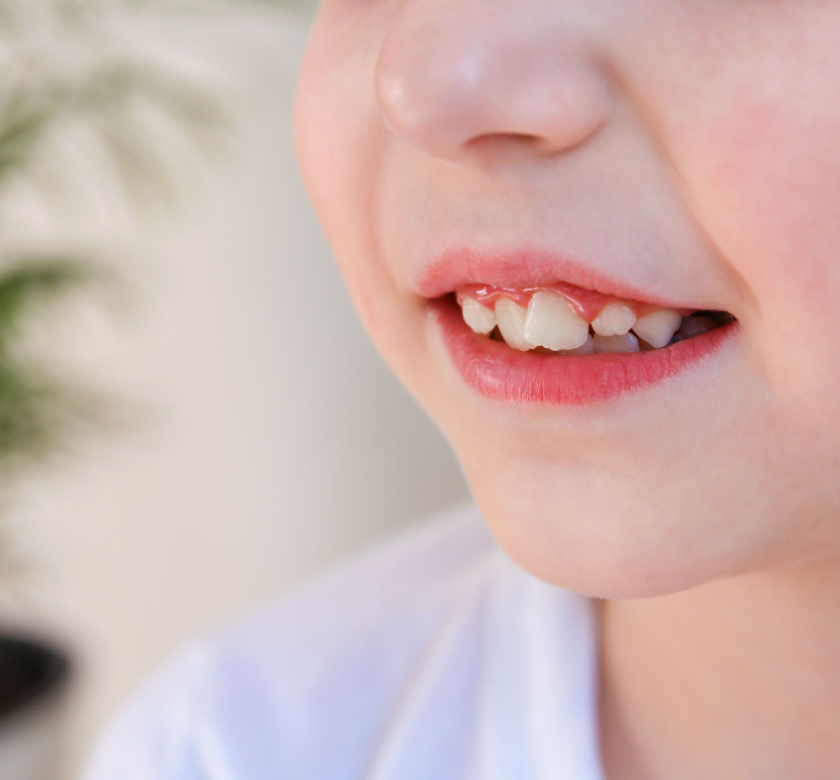 Child Has Crooked Teeth