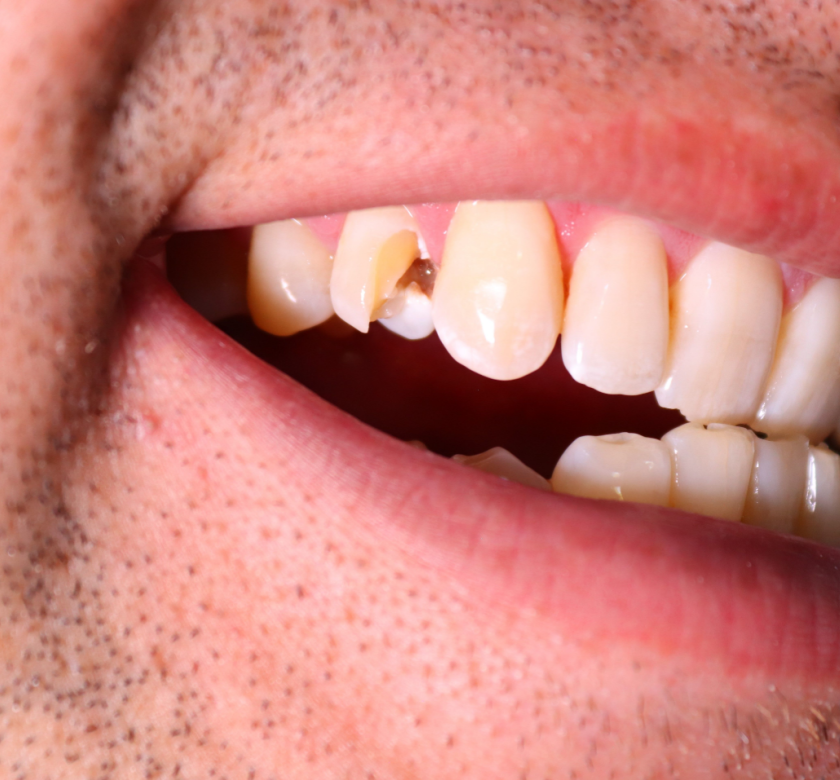 chopped tooth dental emergency