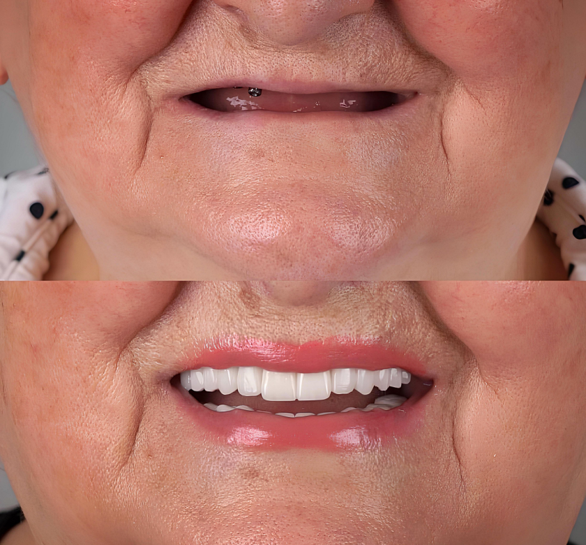 conventional dentures before and after