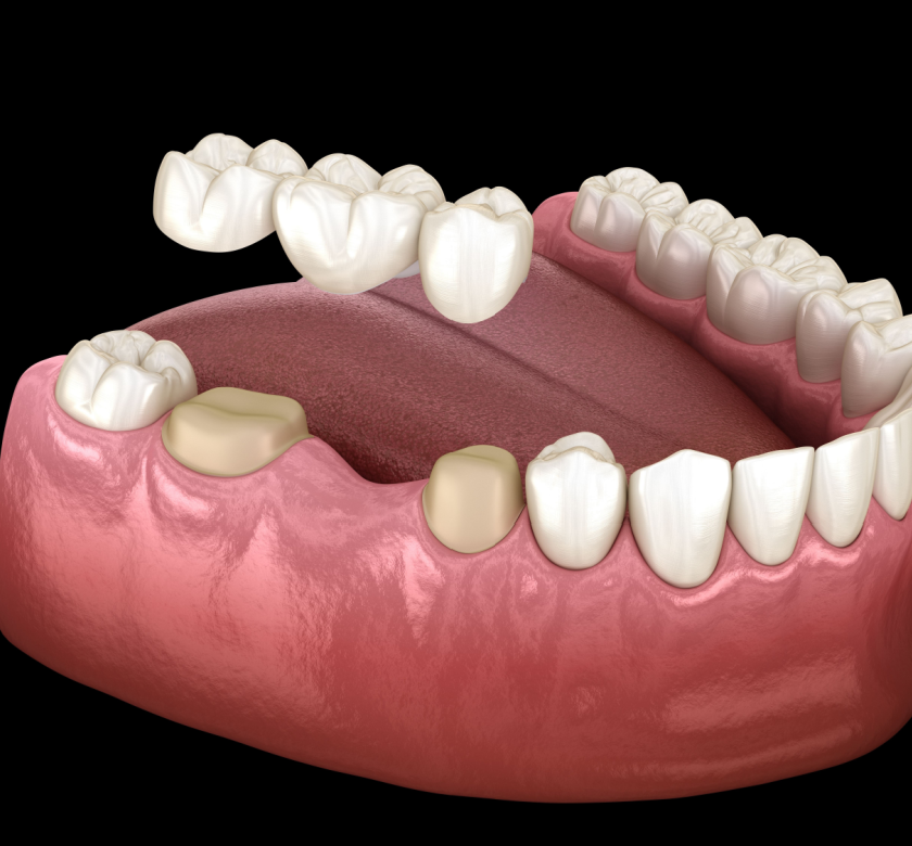 dental bridges burke va