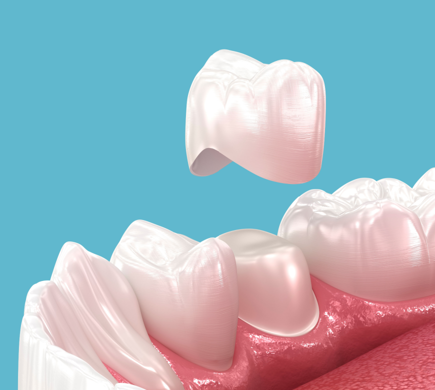 dental crowns burke va