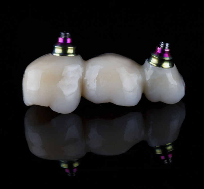 dental implant bridge