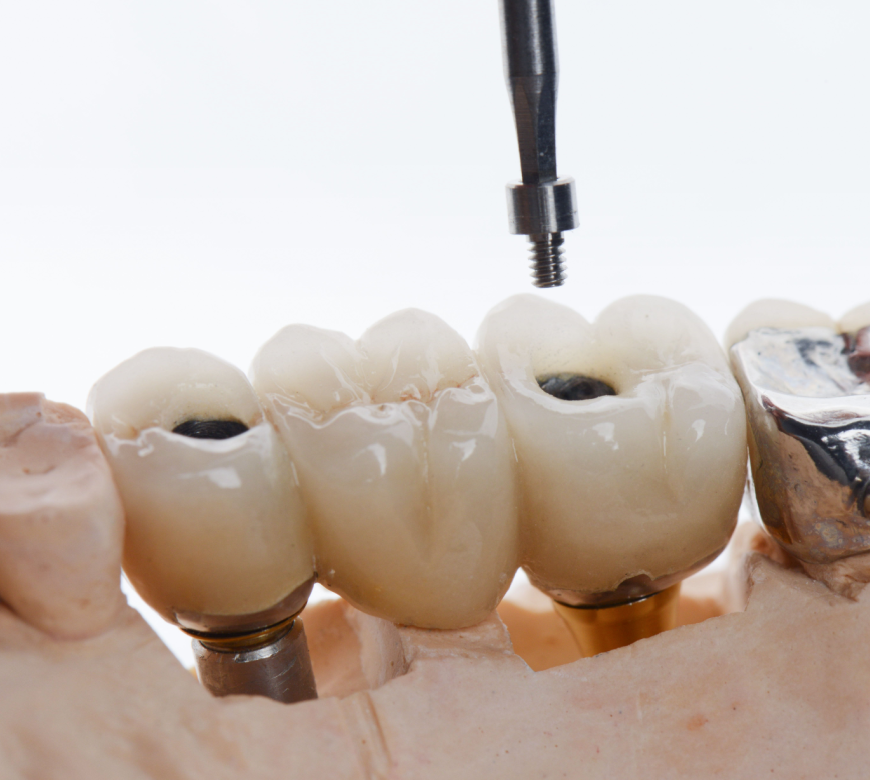 dental implant bridge burke va