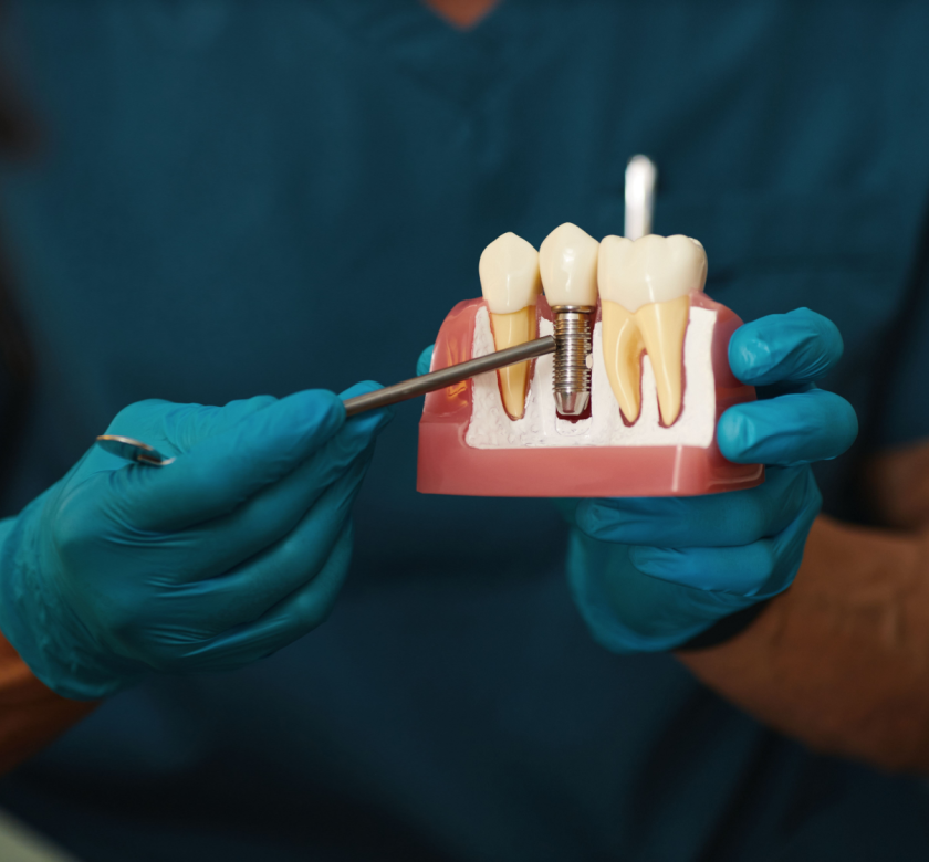 dental implant burke va process