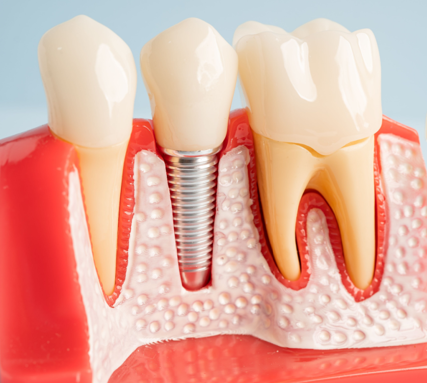 dental implants burke va