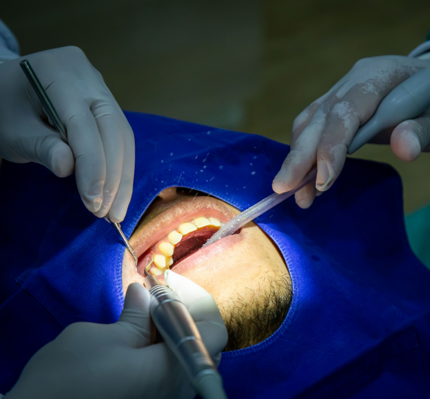 scaling and root planing procedure