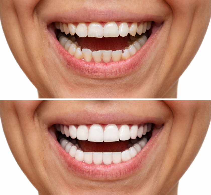 dental veneer smile transformation
