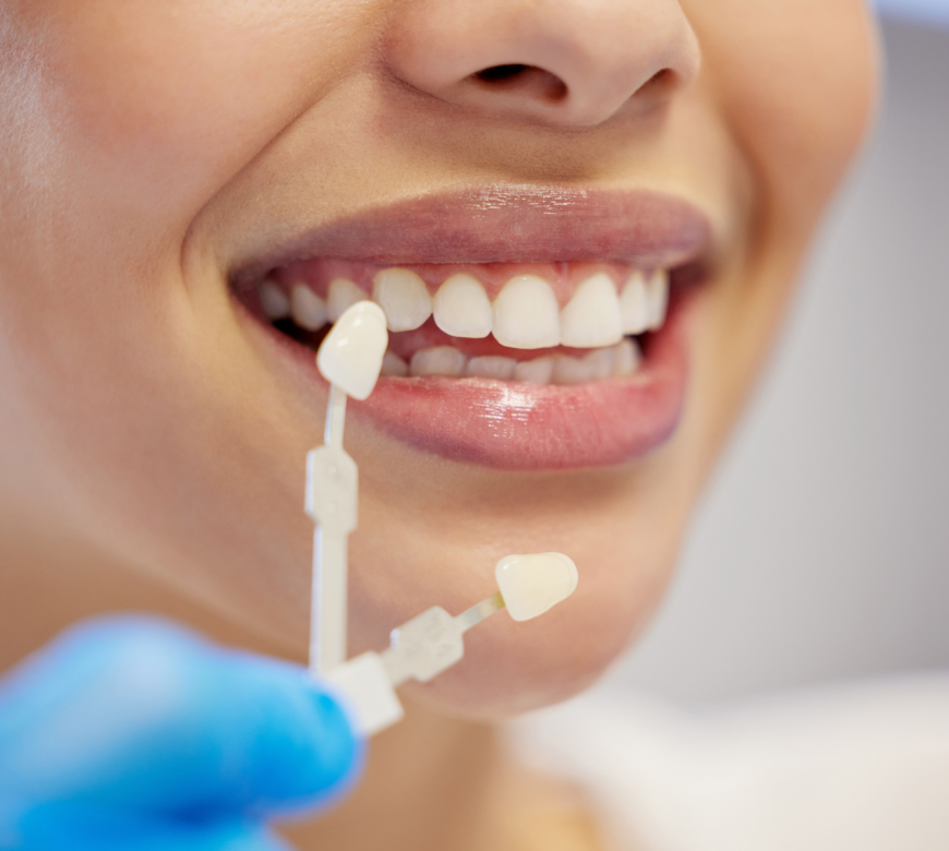 dental veneers in burke va