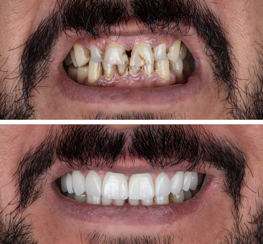 smile makeover dentist in burke va before and after example