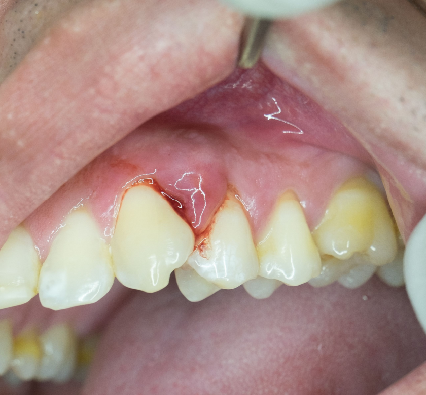 patient with periodontal gum disease burke va