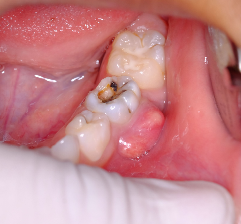 patient receiving periodontal gum surgery in burke va