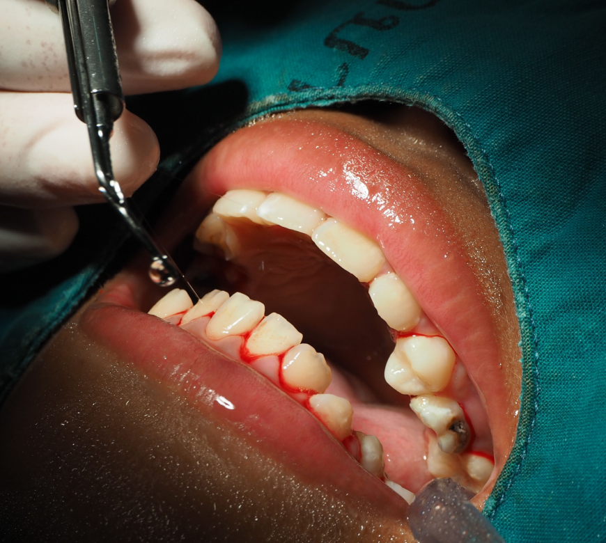 scaling and root planing burke va