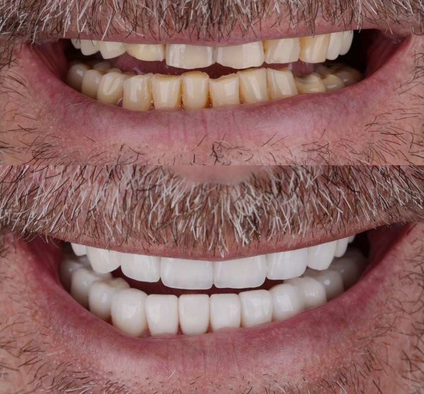 Smile Makeover Before After