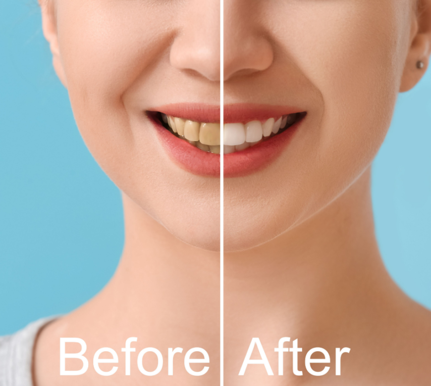 Smile Makeovers In Burke VA