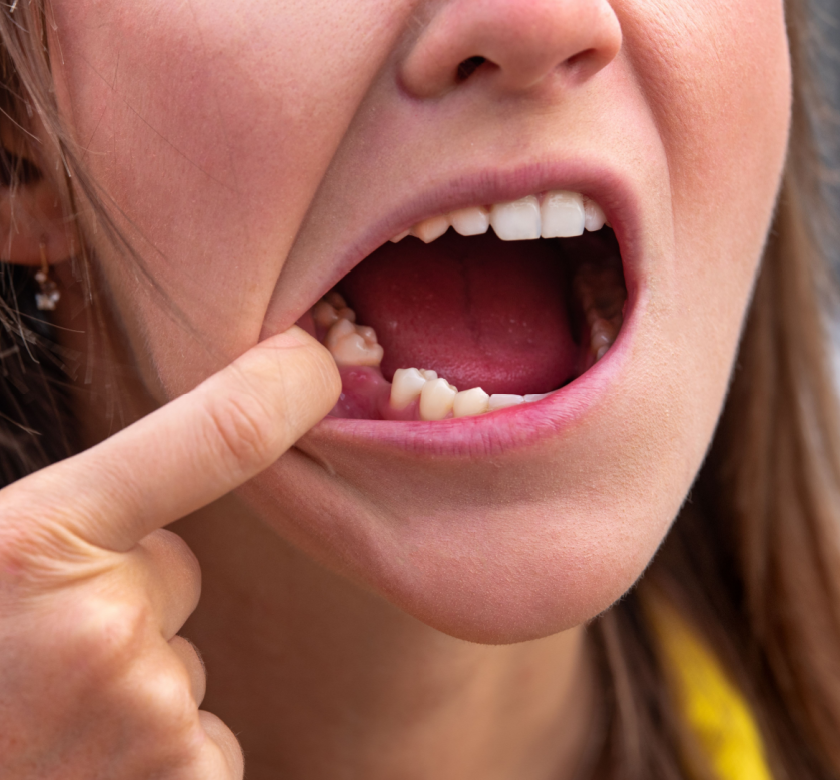 tooth extraction and grafting