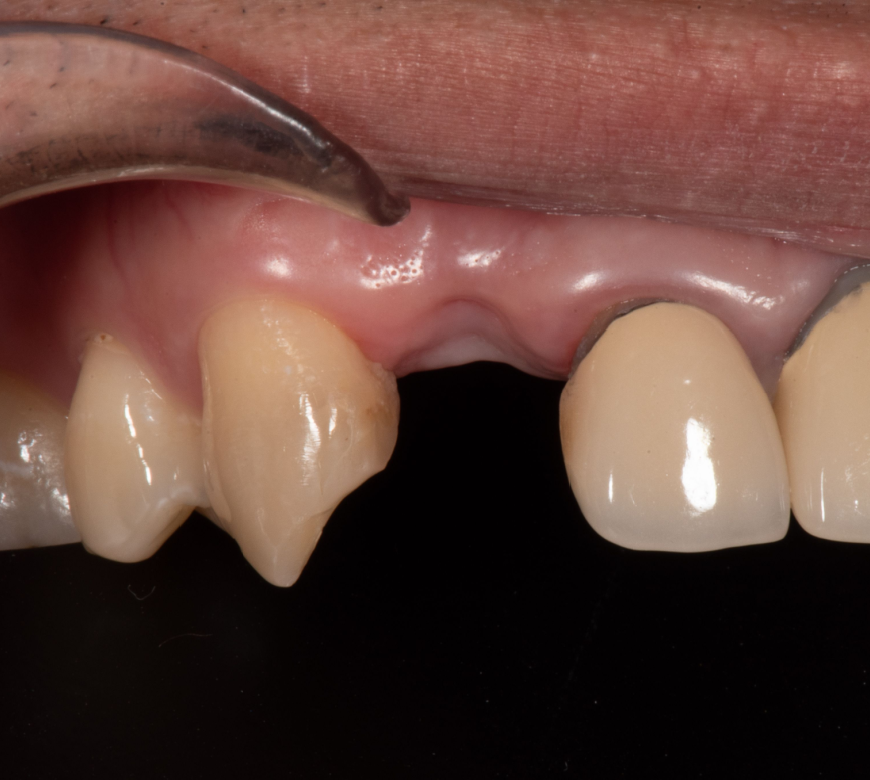 patient after a tooth extractions in burke va