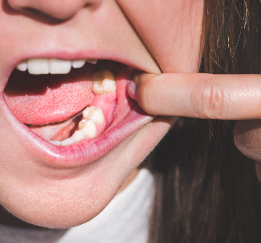 tooth extraction in burke va